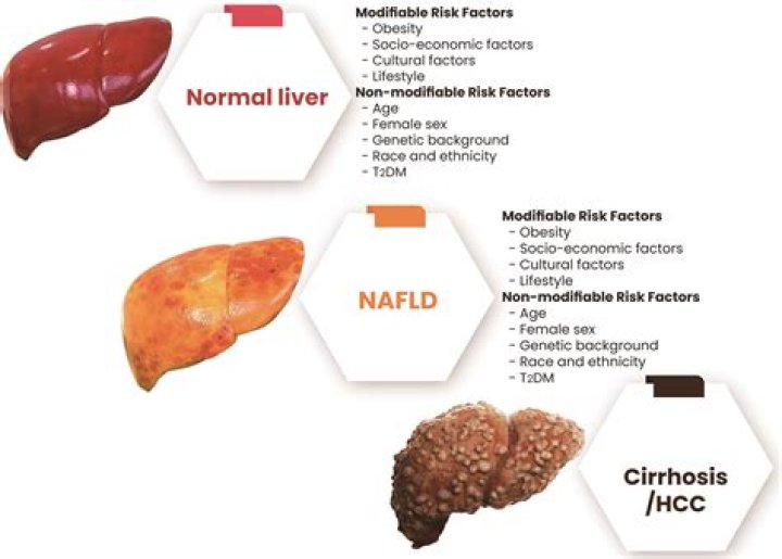 What is nonalcoholic hepatic steatosis (NHS)?