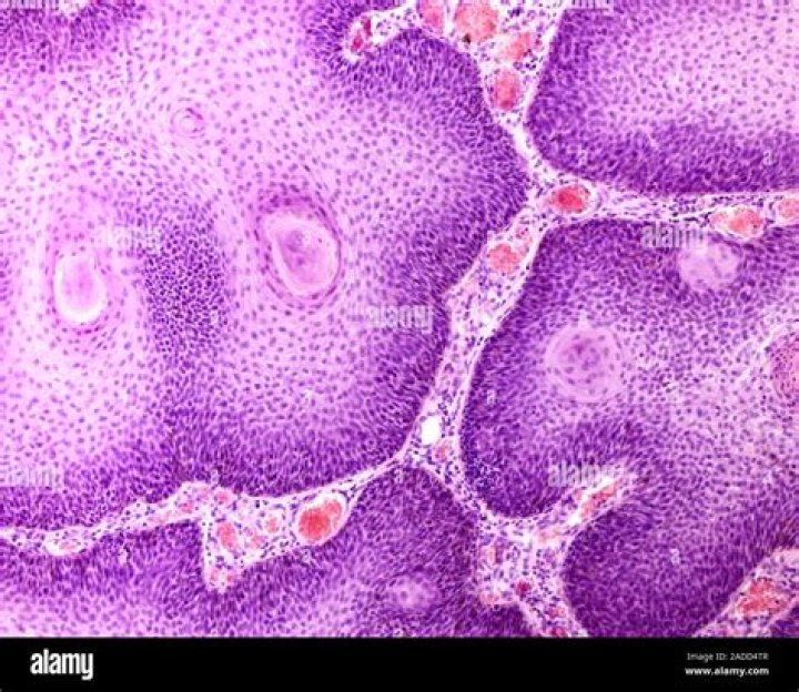 What is papilloma of larynx?