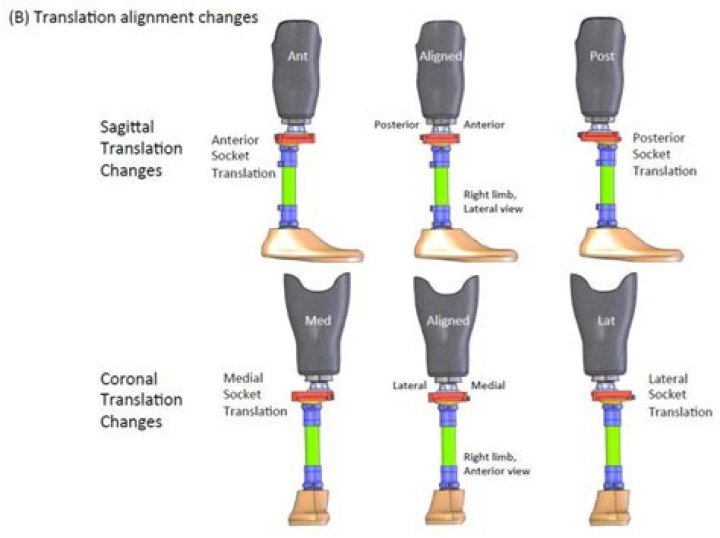 What is prosthetic alignment?