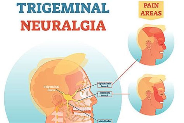 What is PSR for trigeminal neuralgia?