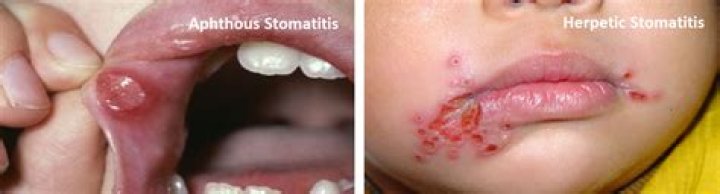What is stomatitis caused by?