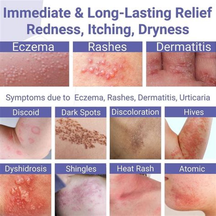 What is the best product to treat eczema?