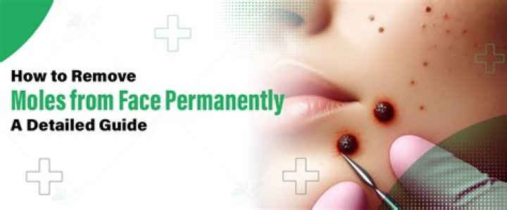 What is the best way to remove moles from face?