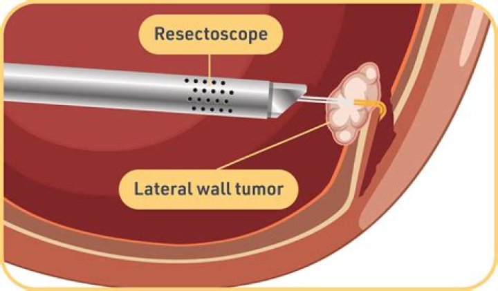 What is the CPT code for TURP partial resection first stage?