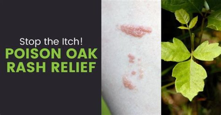 What is the difference between poison ivy and poison oak rashes?