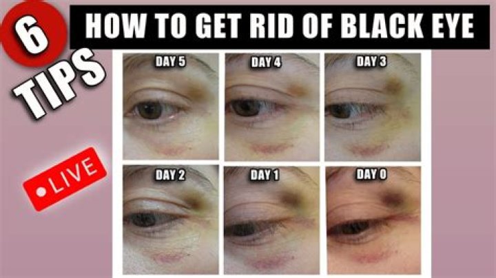 What is the fastest way to get rid of a black eye?