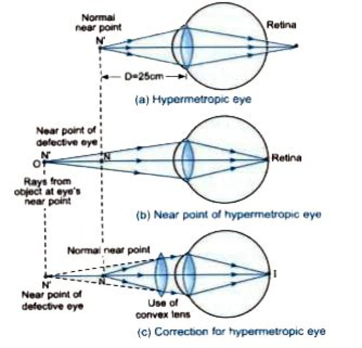 What is the near point of normal eye?
