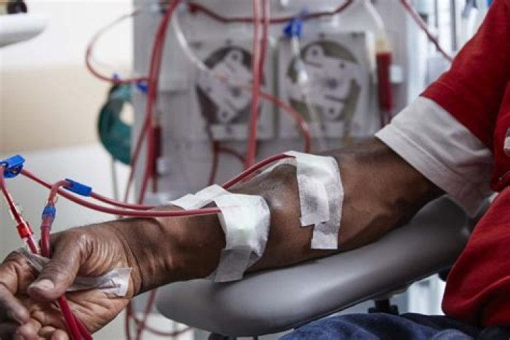 What is the preferred access for hemodialysis?