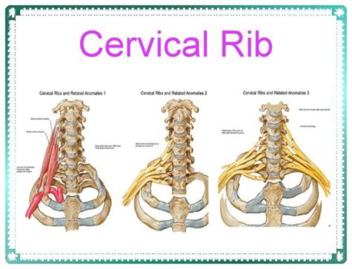 What is the treatment for cervical rib?