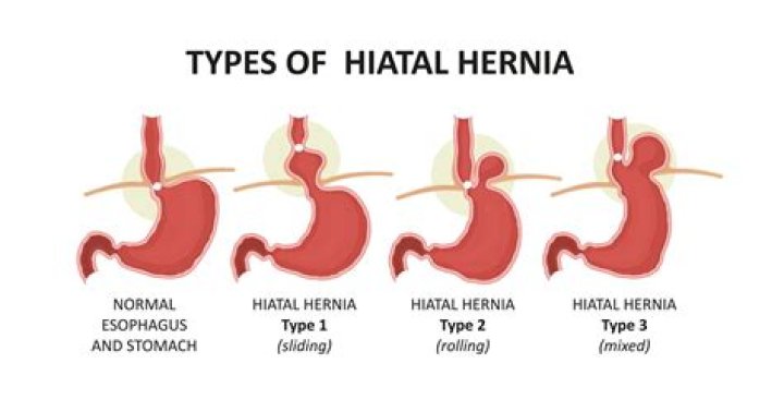 What is Type 3 hiatal hernia?