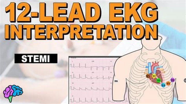 What leads show a STEMI?