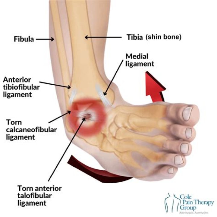 What ligaments did Marcus Lattimore tear?