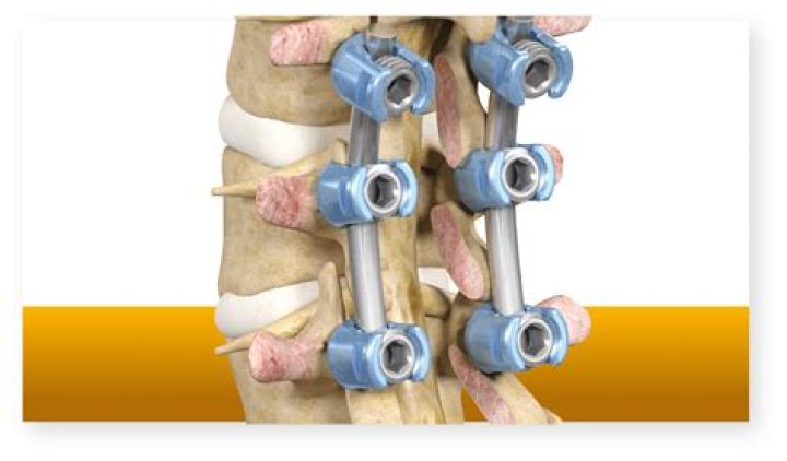 What metal is used for spinal fusion surgery?