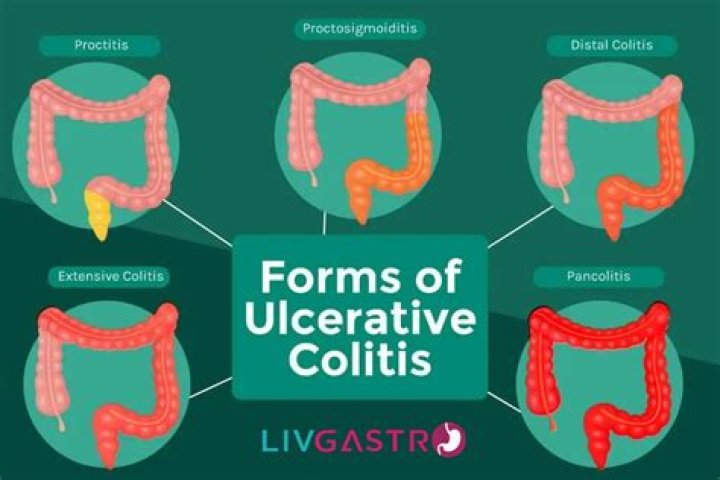 What painkillers can you take with ulcerative colitis?
