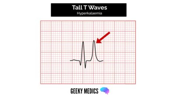 What should an ECG show?