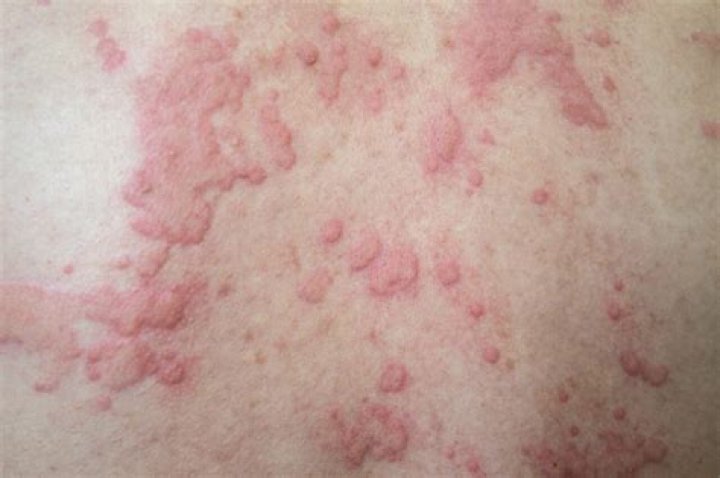 What skin problems do you get with HIV?