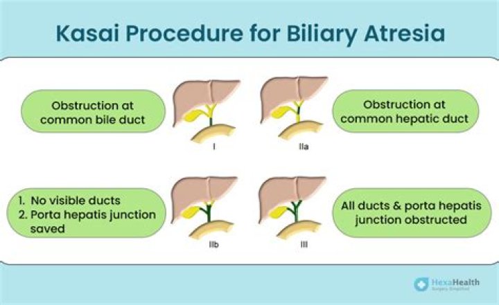 When is Kasai procedure done?