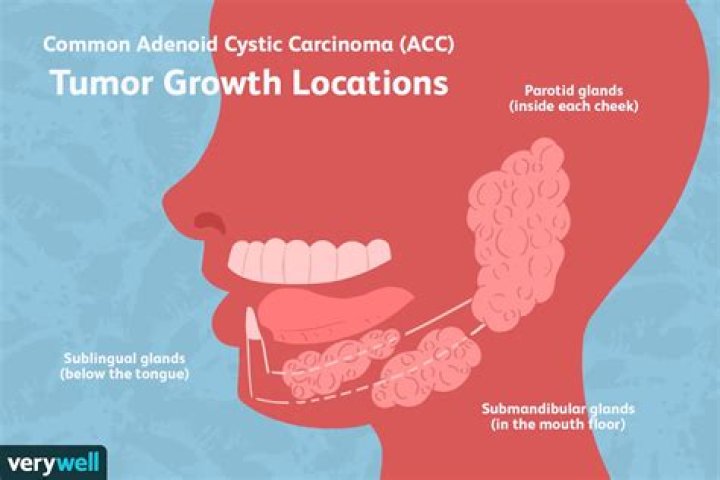 Where does adenoid cystic carcinoma metastasis?