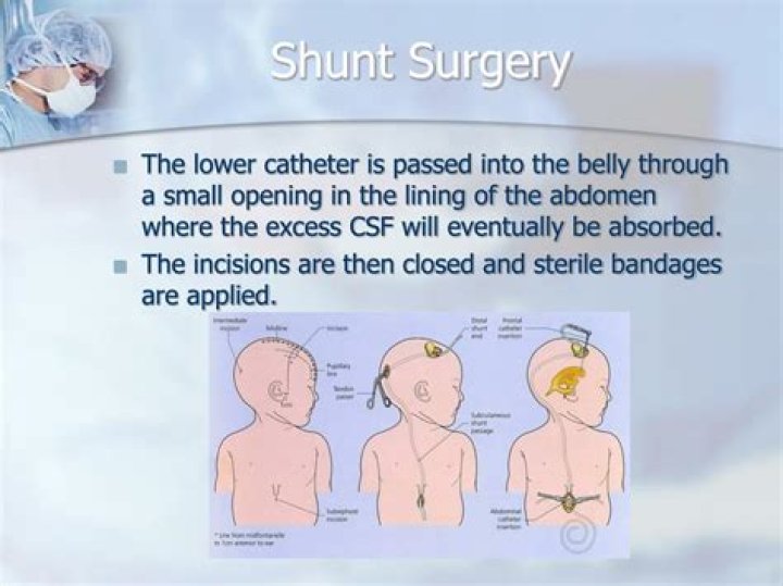 Who performs shunt surgery?