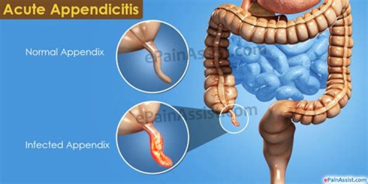 Why appendix carry is bad?
