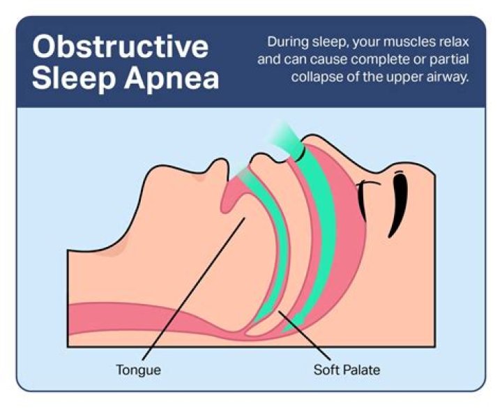 Why are so many people getting sleep apnea?