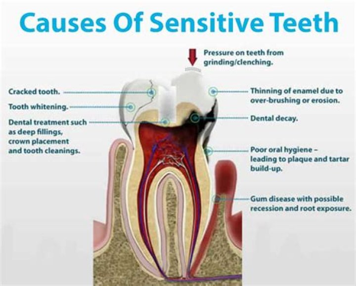 Why did my teeth get sensitive all of a sudden after getting something hot?