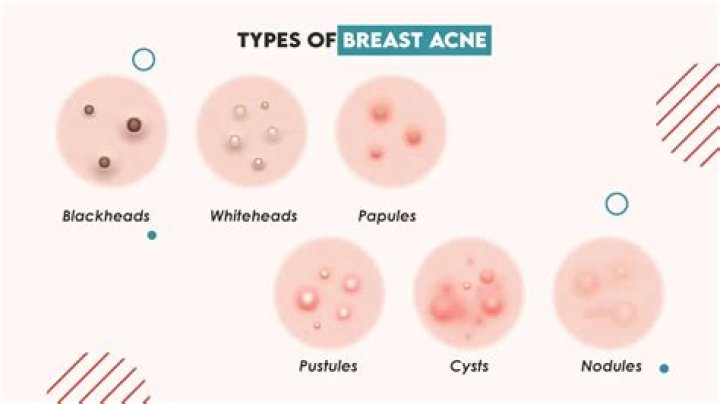 Why do I have a tiny red dot on my breast?
