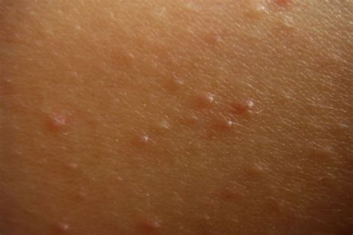 Why do I have little red bumps all over me?