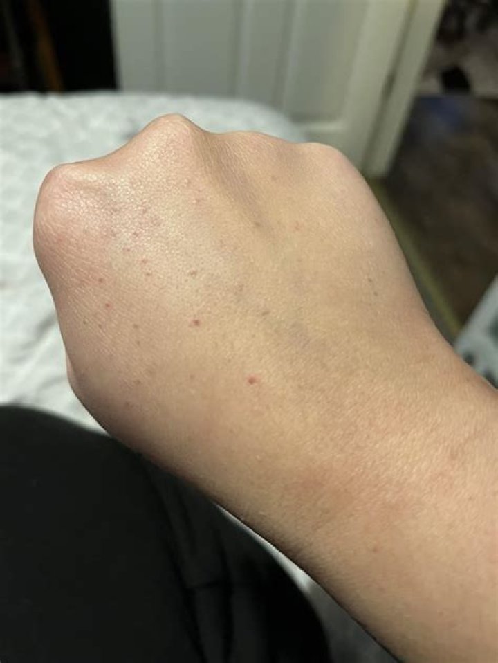 Why do I have small itchy bumps on my arms and hands?