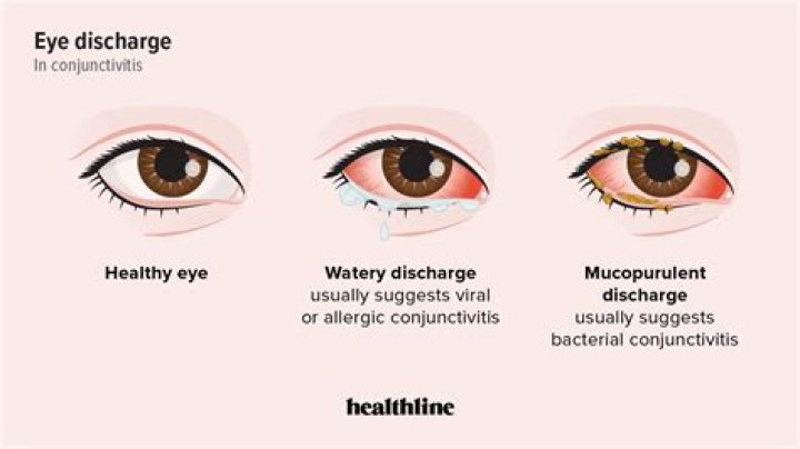 Why do my eyes make so much mucus?