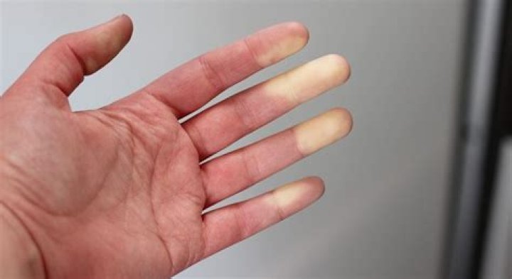 Why do my fingers go white when I walk?