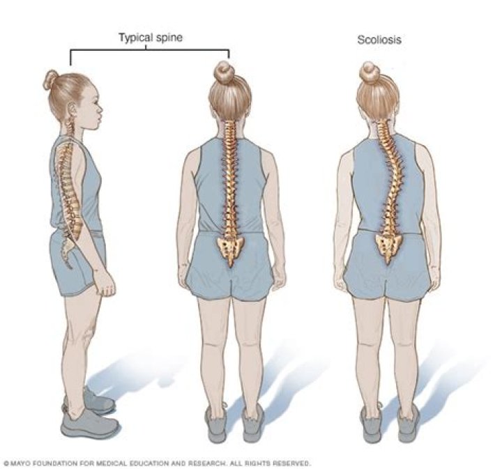 Why does my back pop with scoliosis?