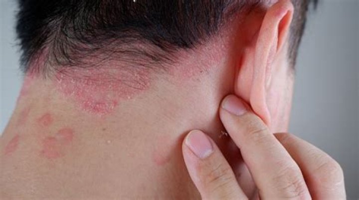 Why does my scalp itch and burn?