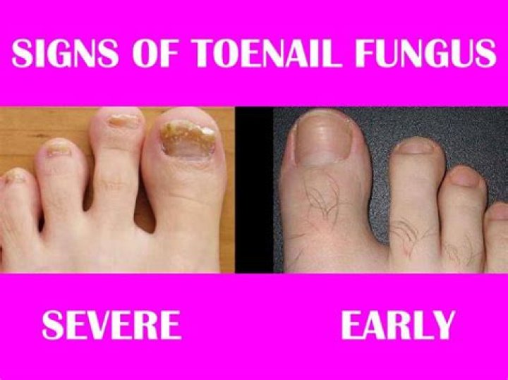 Why does my toenail fungus hurt?