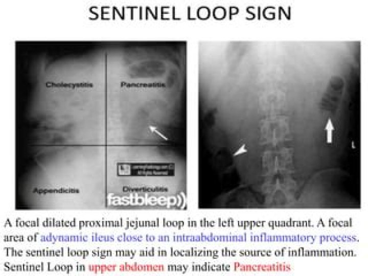 Why does Sentinel loop pancreatitis?