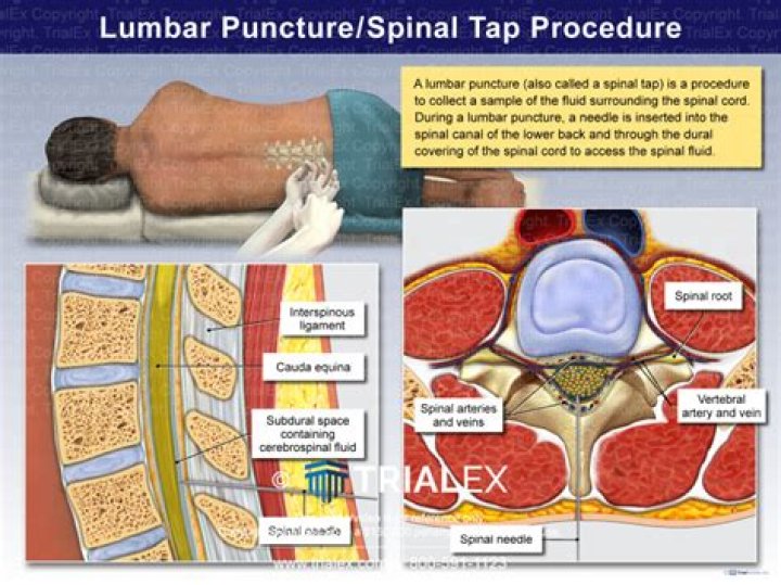Why would they do a spinal tap for headaches?