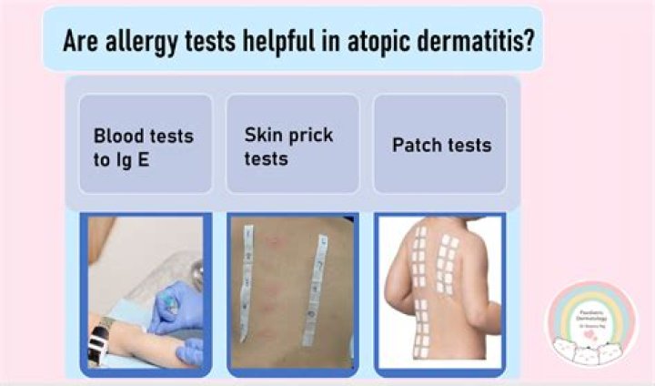 Will allergy testing help eczema?